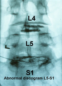 Discography procedure for discogenic back pain diagnosis in Jaipur