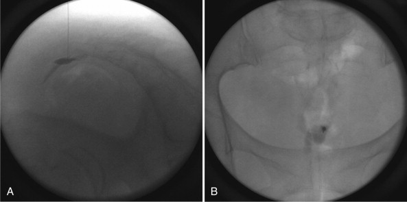 Ganglion impar block treatment illustration for tailbone and pelvic pain in Jaipur